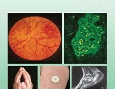 Atlas of Diabetes Mellitus 4th Edition