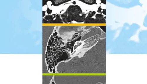 Imaging Handbook on Anatomy of Cochlea